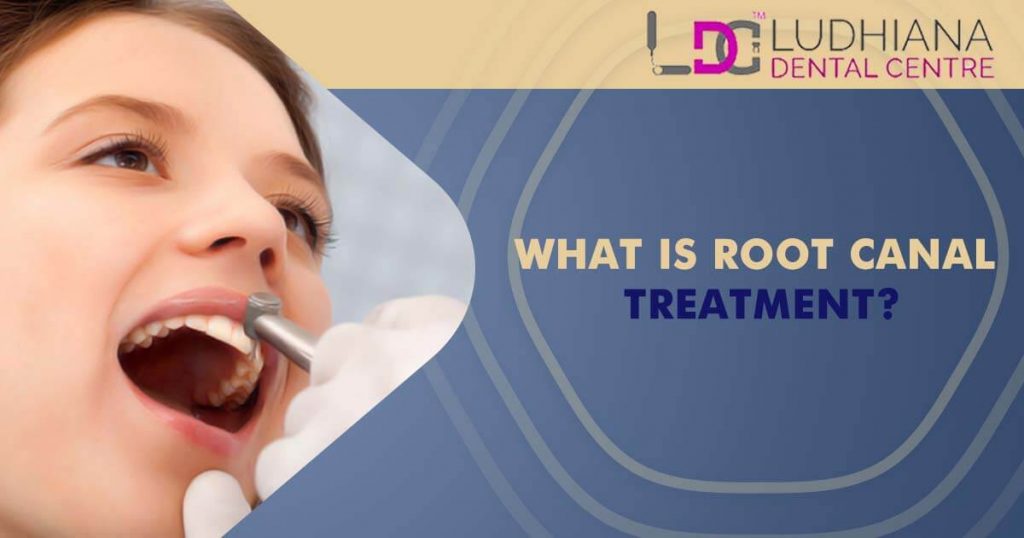 What is root canals treatment?