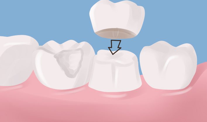 Dental Crown: A Strength, Protector, And Enhancer For The Teeth