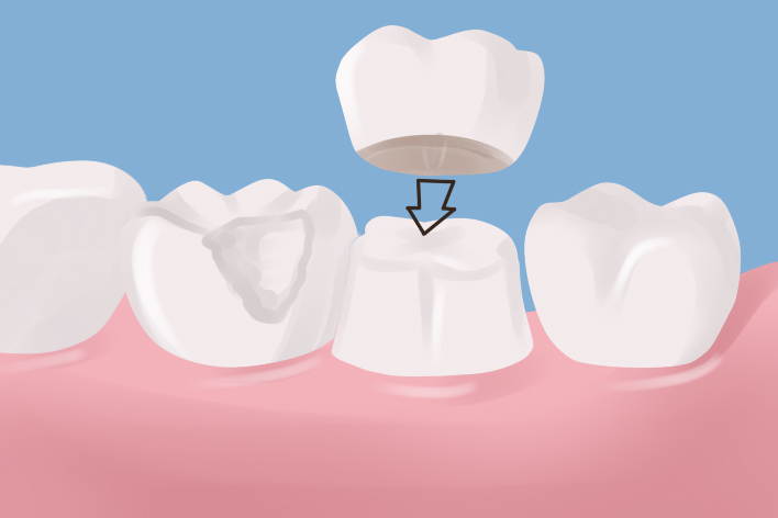 Dental Crown: A Strength, Protector, And Enhancer For The Teeth