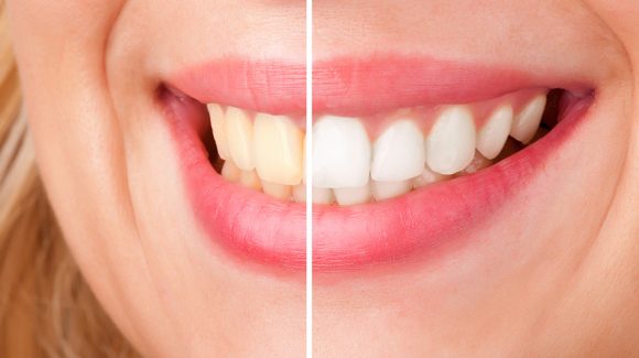 Let’s clear up everything about the teeth whitening treatment