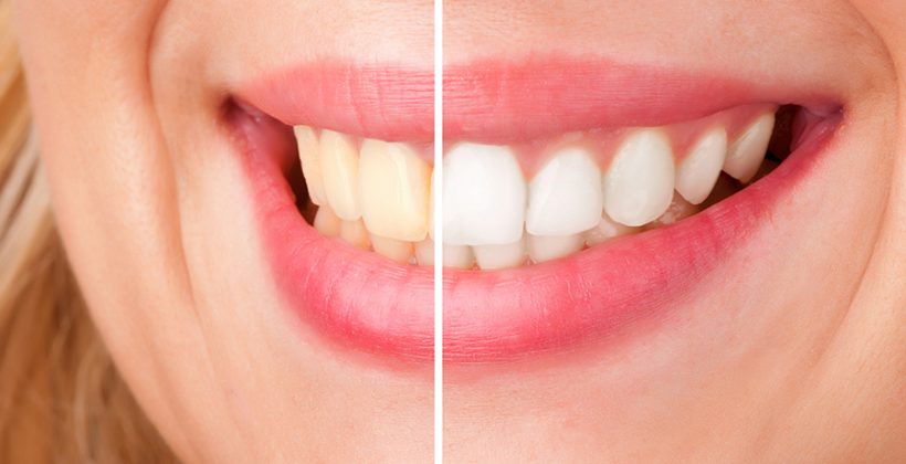 Let’s clear up everything about the teeth whitening treatment