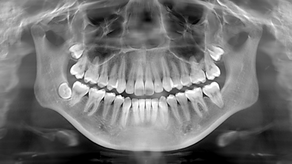 Facts About Dental X-Rays
