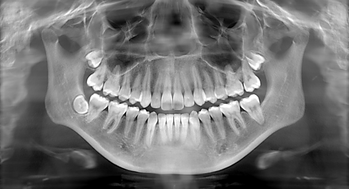 Facts About Dental X-Rays