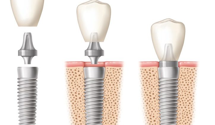 Know About Dental Implants: Overview, Types, Procedure And What To Expect