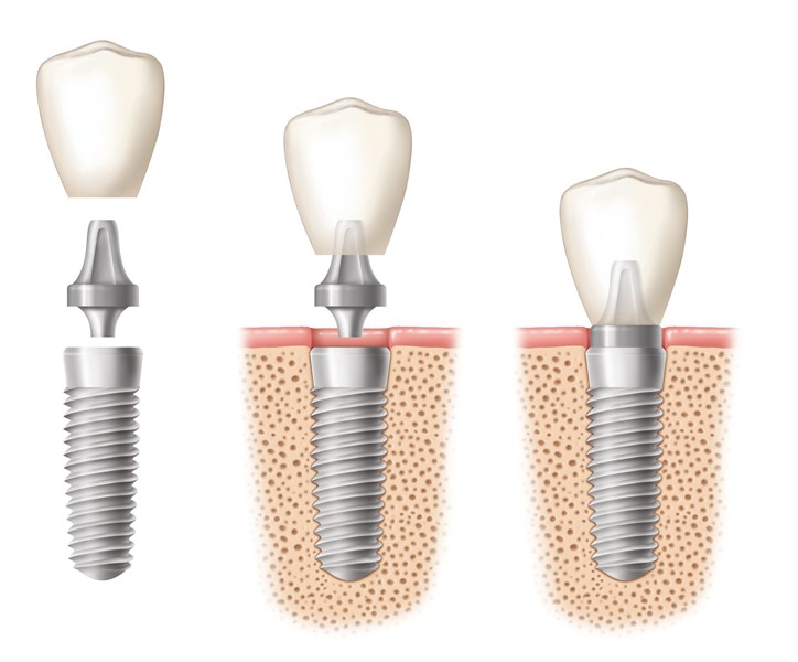 Know About Dental Implants: Overview, Types, Procedure And What To Expect