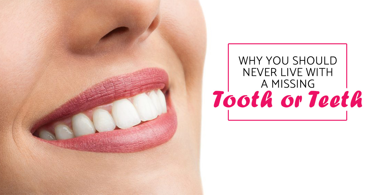 Why you should never live with a missing tooth or teeth
