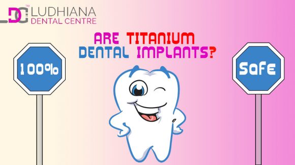 Are Titanium Dental Implants 100% Safe?