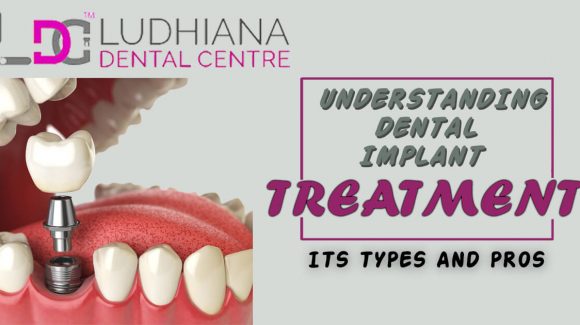 Dental Implant Treatment -Its Types And Its Ultimate Pros