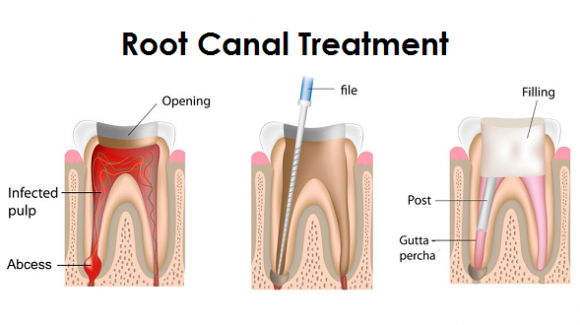 Procedure of Root Canal Treatment