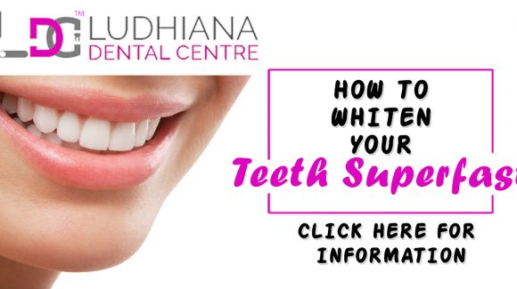 Different Procedures For The Teeth Whitening Treatment