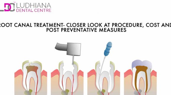 Root Canal Treatment – Closer Look at procedure, cost and post preventative measures