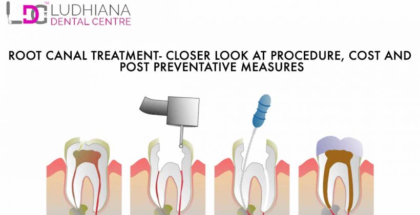 Root Canal Treatment – Closer Look at procedure, cost and post preventative measures