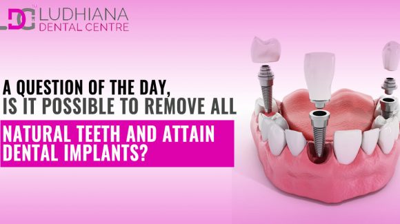A question of the Day, Is it possible to remove all natural teeth and attain Dental Implants?
