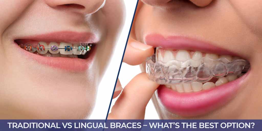Traditional VS Lingual Braces – What’s the Best Option?
