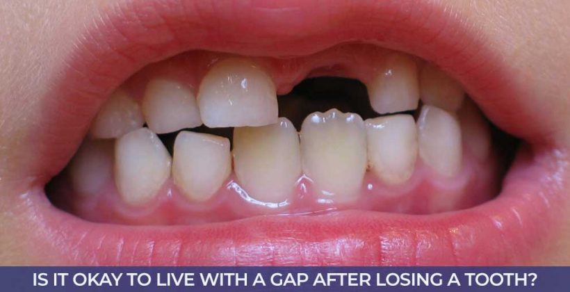 Is it Okay to Live With a Gap After Losing a Tooth?