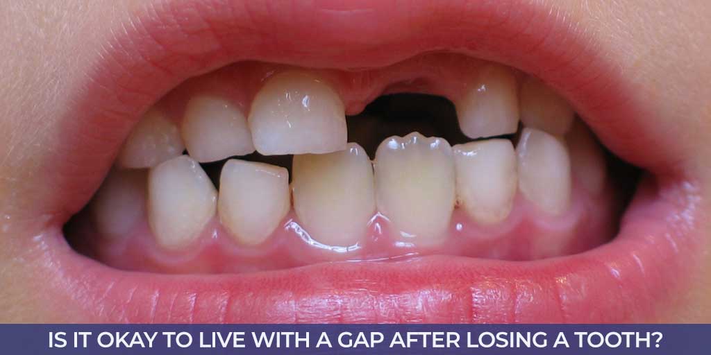 Is it Okay to Live With a Gap After Losing a Tooth?