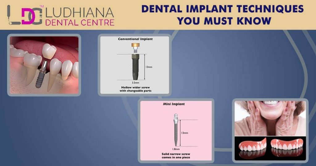 Dental Implant Techniques You Must Know 