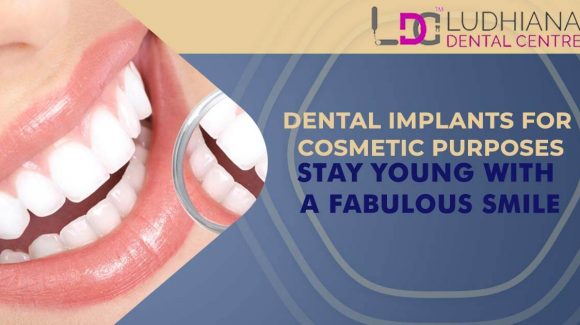 Dental Implants For Cosmetic Purposes- Stay Young With a Fabulous Smile