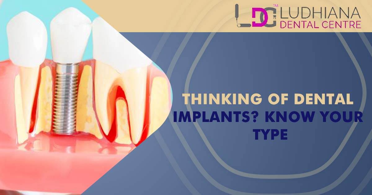 Thinking of Dental Implants? Know Your Type