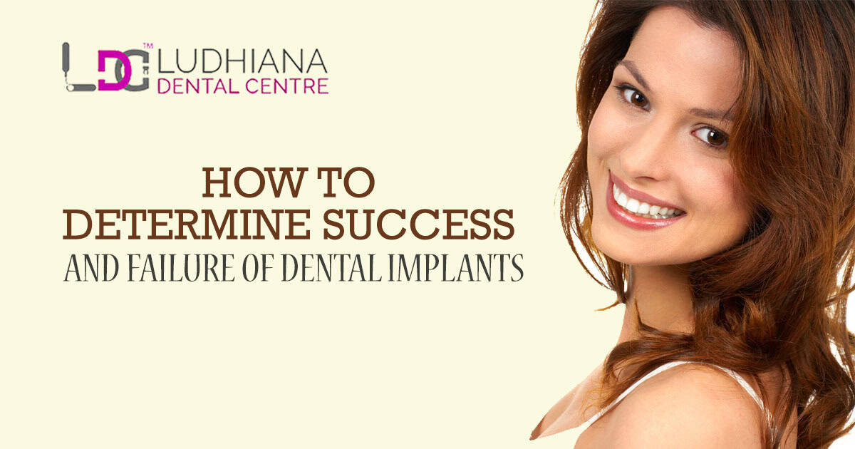 How to Determine Success and Failure of dental implants?