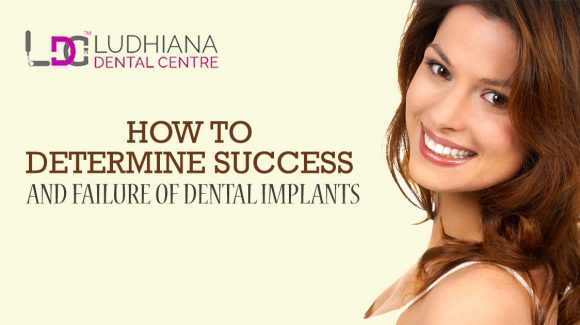 Best Dental Clinic in Doraha | Affordable Dental Implants Treatment