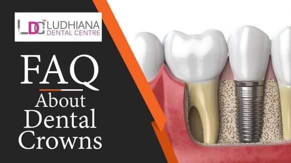 Frequently Asked Questions About Dental Crowns