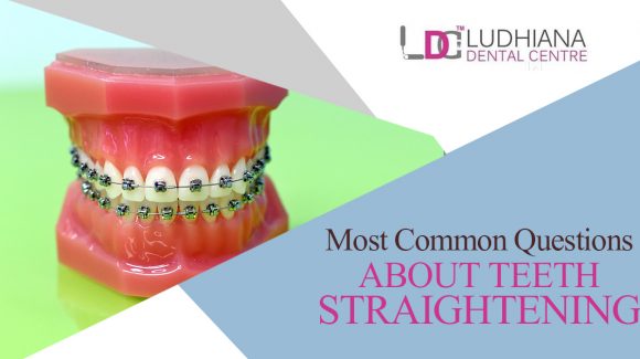 Most Common Questions About Teeth Straightening