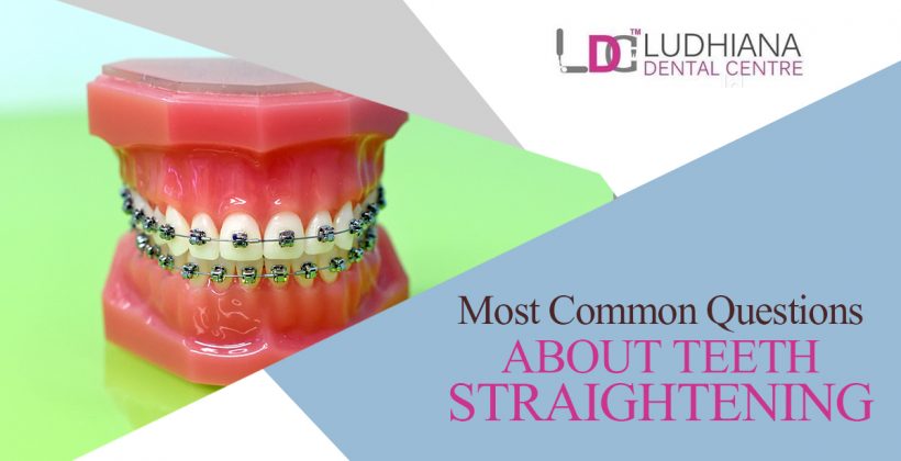 Most Common Questions About Teeth Straightening