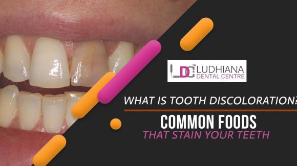 What Is Tooth Discoloration? Common Foods That Stain Your Teeth