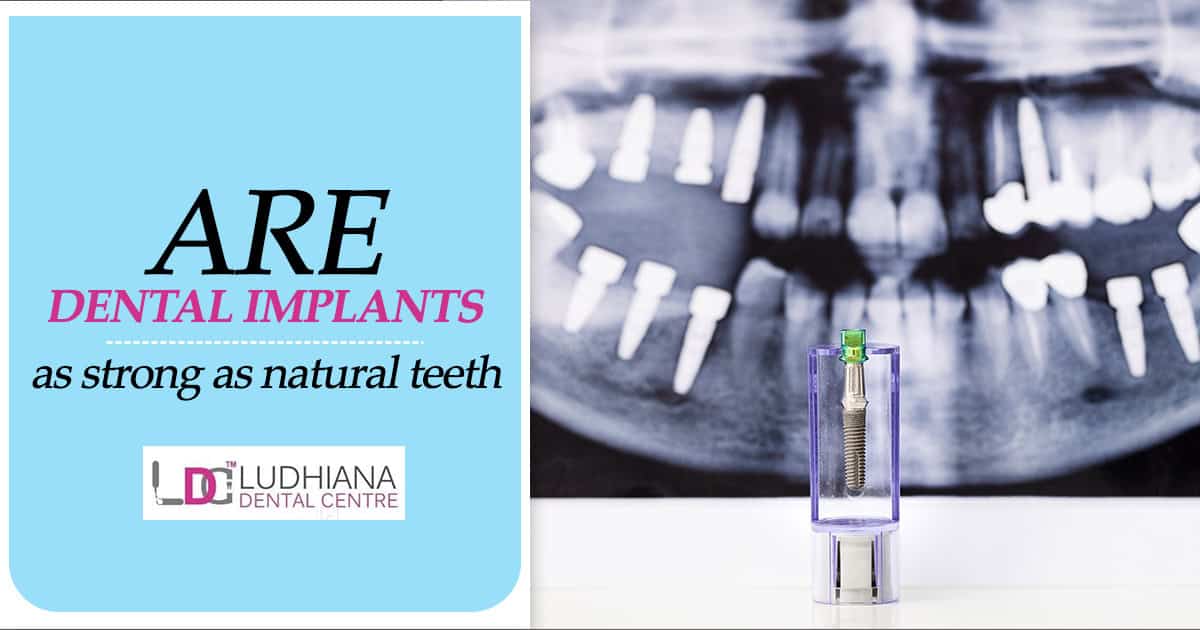 are dental implants as strong as natural teeth.