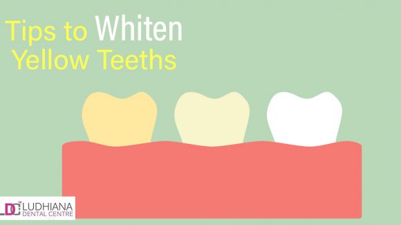 Tips to whiten Yellow Teeth