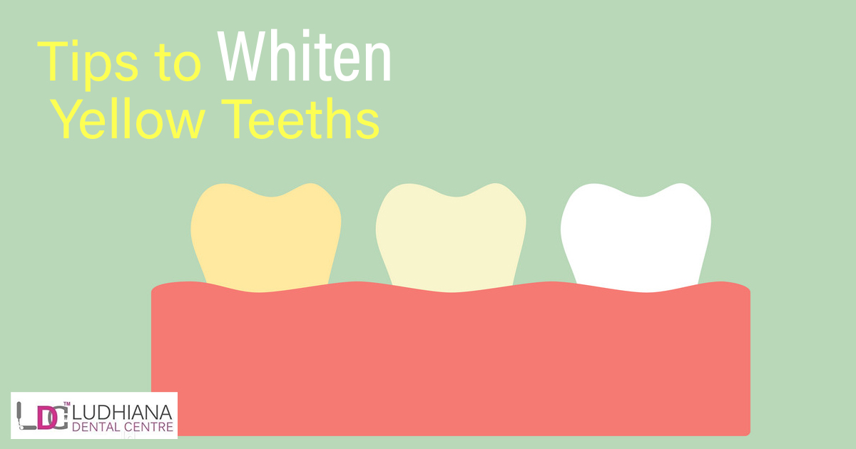Tips to whiten Yellow Teeth