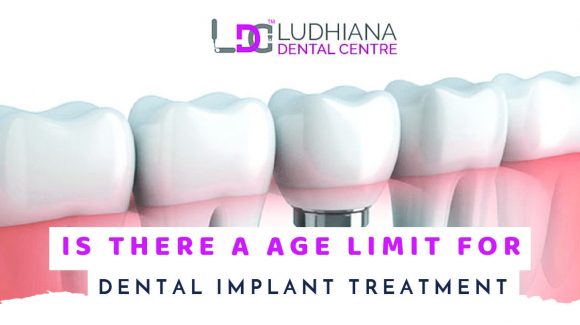 Is There A Age Limit For Dental Implant Treatment