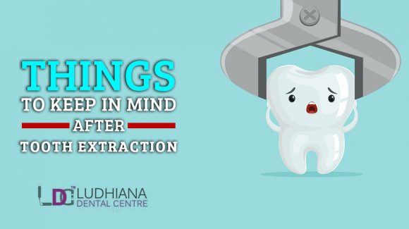 Things to Keep in Mind After Tooth Extraction