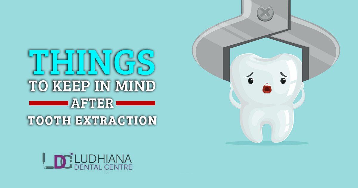 Things to Keep in Mind After Tooth Extraction
