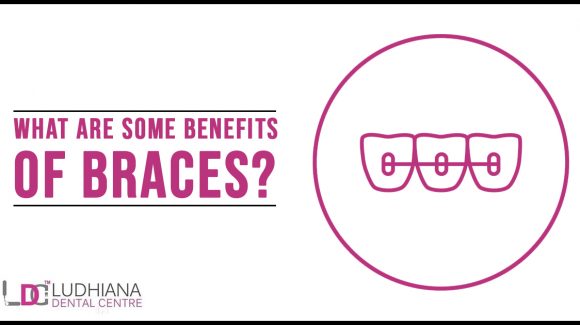 What are some benefits of Braces?