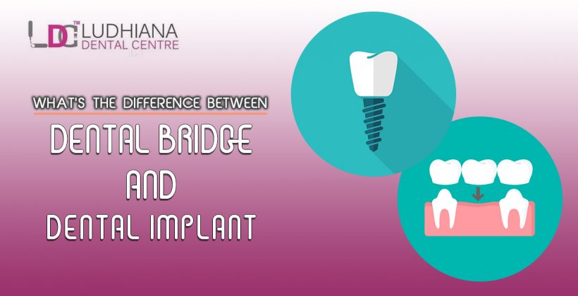 What’s the Difference Between Dental Bridge and Dental Implant