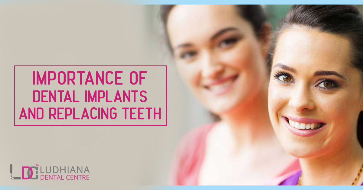 Importance of Dental Implants And Replacing Teeth