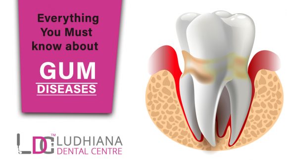 Everything You Must know about Gum Diseases