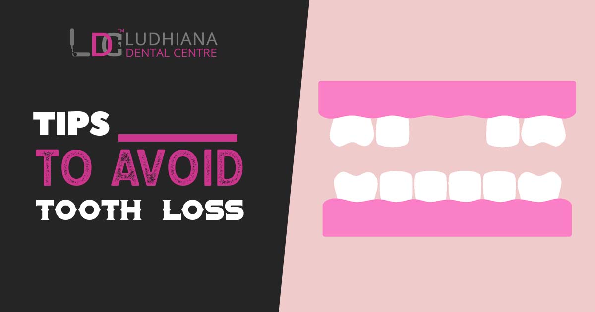 Tips to Avoid Tooth Loss