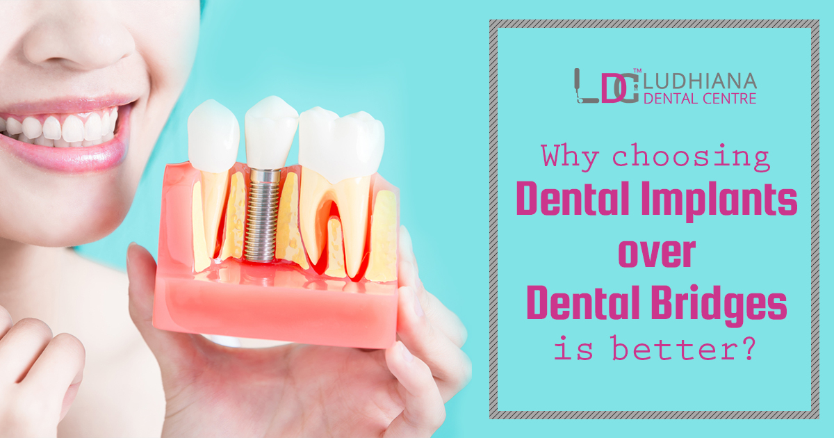 Why choosing Dental Implants over Dental Bridges is better?