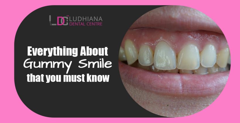 Everything About Gummy Smile that you must know