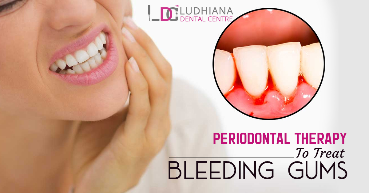 Periodontal Therapy to Treat Bleeding Gums