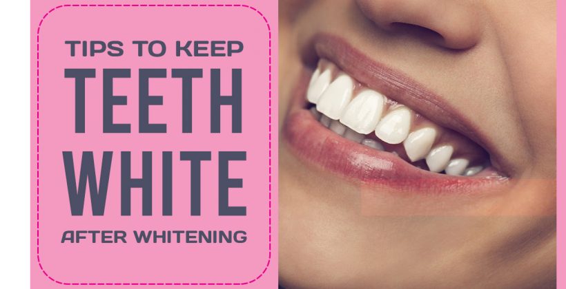 Teeth whitening treatment: How long do the procedure results last?