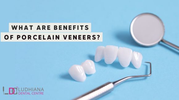 What are Benefits of Porcelain Veneers?