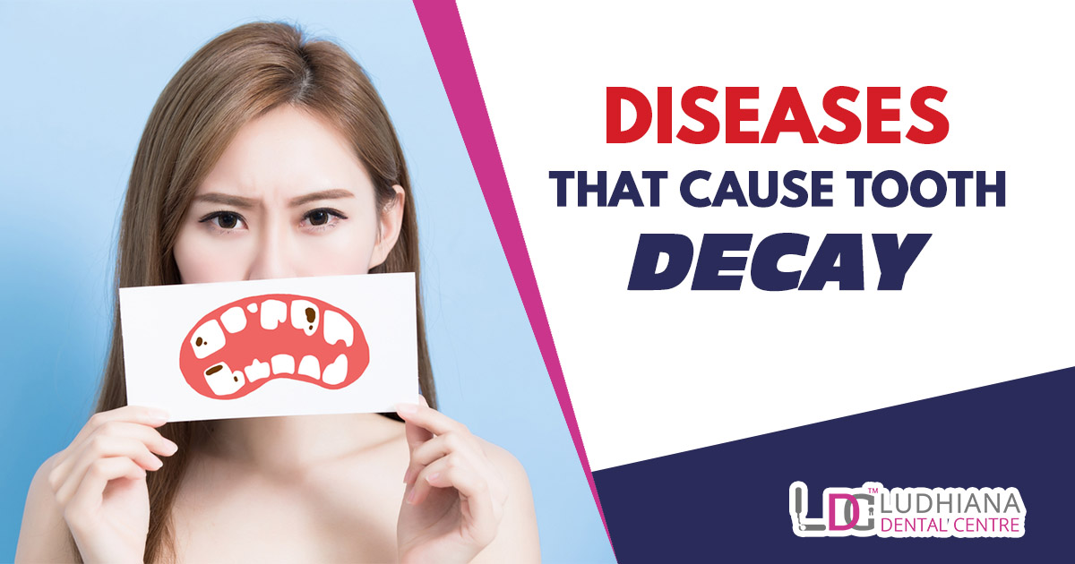 Diseases that cause tooth decay