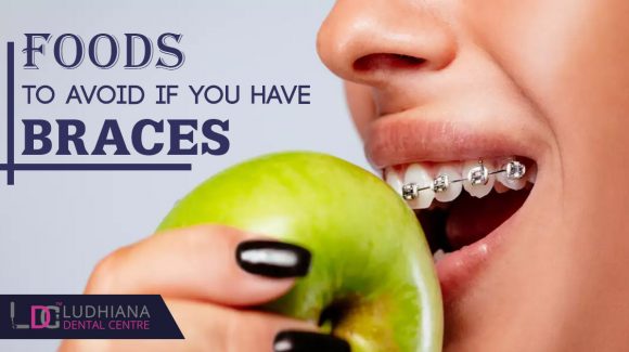 Foods to avoid if you have braces