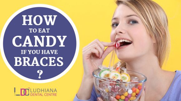 How to Eat Candy if You have Braces?