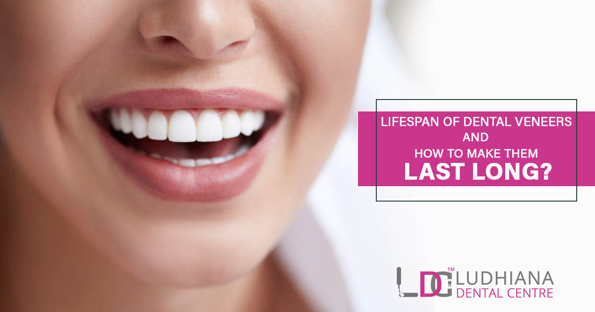 LifeSpan of Dental Veneers and How to Make them last long?