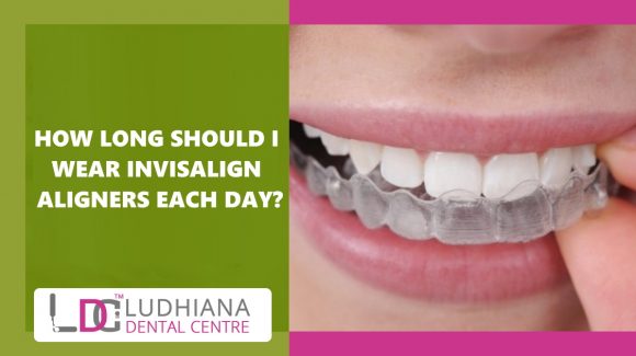 How Long Should I Wear Invisalign Aligners Each Day?